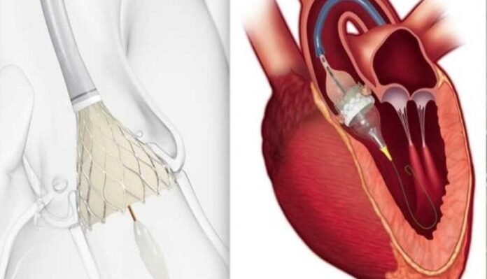 Transcatheter Heart Valve Replacement (TAVR) Market is expected to reach US$ 25.4 Billion by end of 2033 | Future Market Insights, Inc.